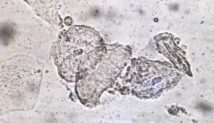 全自動陰道分泌物草莓视频APP免费剖析陰道分泌物的潔淨度規範