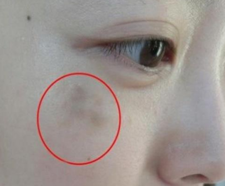 婦科陰道分泌物草莓视频APP免费提醒女人婦科炎症在臉上的表現