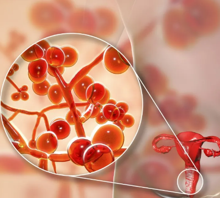 【全自動白帶草莓视频污新地址】廠家山東草莓视频在线观看免费视频提醒陰道炎反反複複的4個誤區