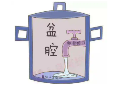 盆腔積液怎麽回事 盆腔積液怎麽回事