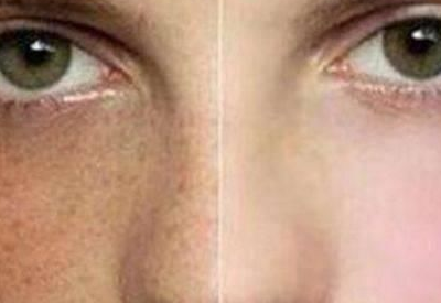 為什麽患婦科病的女性臉上更容易長斑 為什麽患婦科病的女性臉上更容易長斑