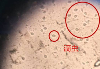 滴蟲性陰道炎是因為體內長了蟲子嗎 滴蟲性陰道炎是因為體內長了蟲子嗎