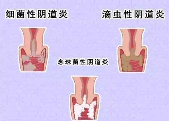 全自動陰道分泌物草莓视频APP免费廠家提醒您還在拖延嗎，還在等陰道炎自愈嗎？